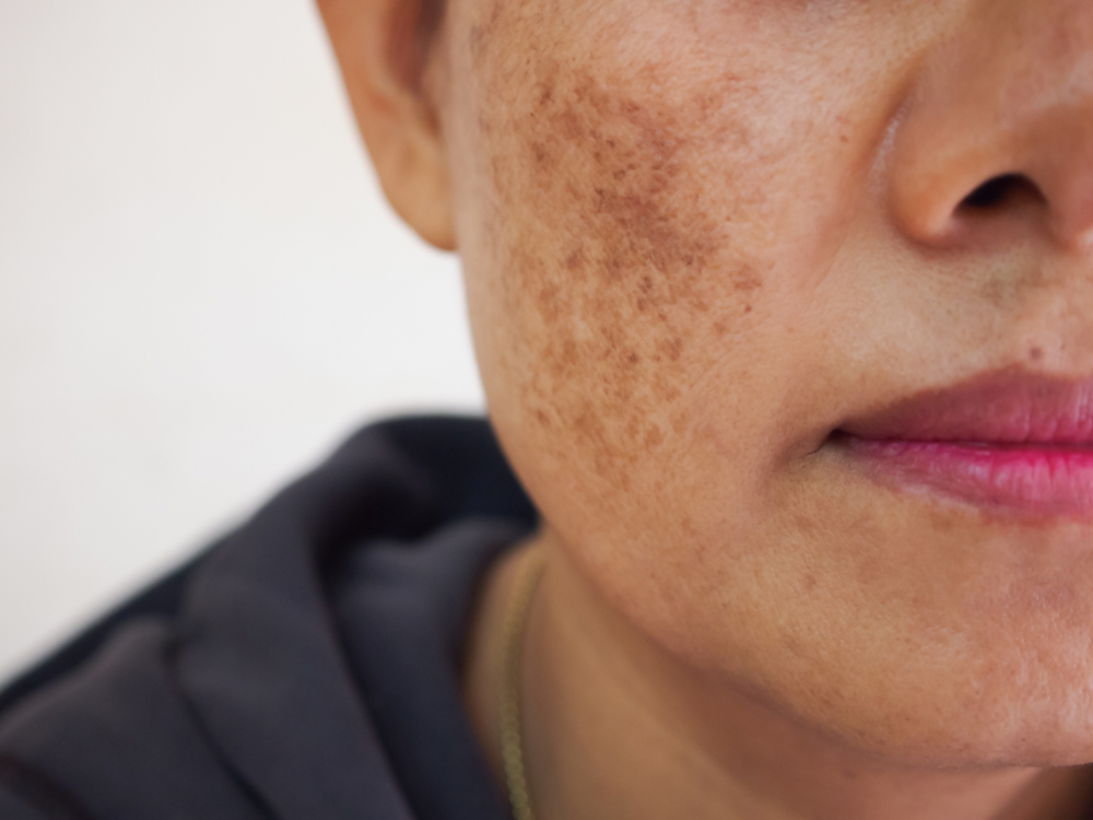 Fight Sunspots and Melasma with a Chemical Peel - Dontage