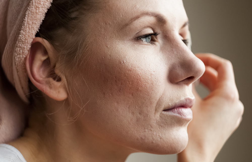 Face Peel for Dry Skin: How It Works + Best Ones