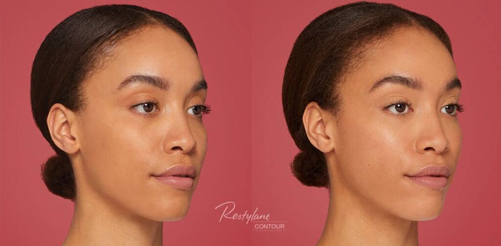 Restylane Contour Northern Virginia