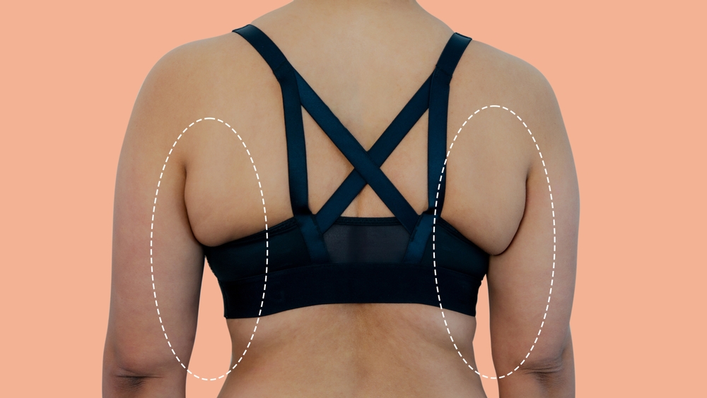 Health Check: How To Nonsurgically Get Rid of Bra Line Fat with Kybella® Fat  Melting