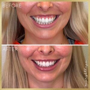 Gummy Smile Gallery - Dontage