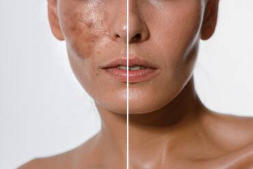 What Are the Best Hyperpigmentation Treatments in Falls Church?