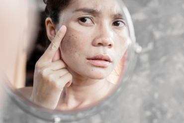 Melasma Treatments Cost in Falls Church