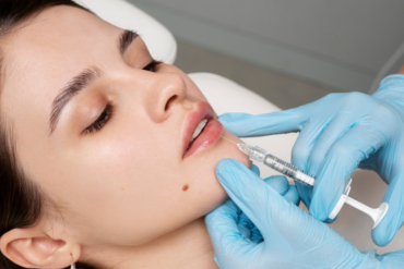 Next-Day Appointments for Lip Fillers Near Fairfax