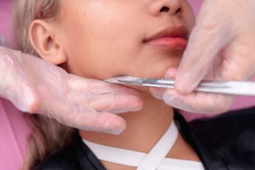 Top Clinic for Dermaplaning Services in Fairfax