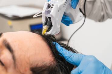 Platelet-Rich Growth Factors Are Revolutionizing Aesthetic Medicine