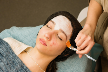 Chemical Peel Treatments for Acne Scars in Falls Church, Virginia