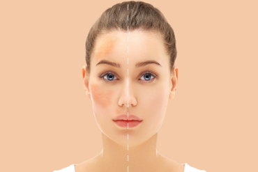Microdermabrasion for Hyperpigmentation Near Ashburn, Virginia