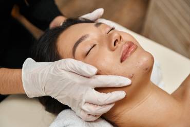 What Are the Best Acne Facial Treatments for Teens and Adults in Falls Church, VA?