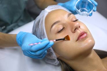 Chemical Peels in Falls Church, VA for Acne Scars and Skin Texture