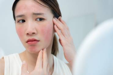 BBL Laser Treatments in Fairfax, VA for Redness, Pigmentation, and Anti-Aging