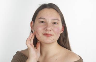 Who Is a Good Candidate for an Acne Facial in Dunn Loring, VA?