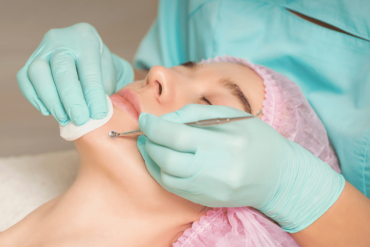 Acne facial treatments in Fairfax VA