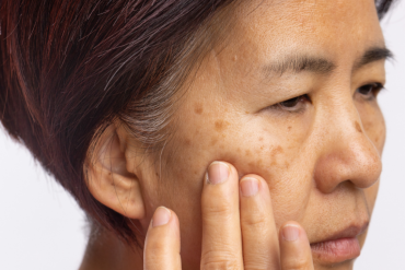 Dark Spot Treatment Near Arlington VA