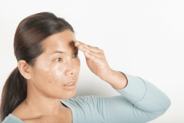Dark Spot Reduction Near Falls Church VA