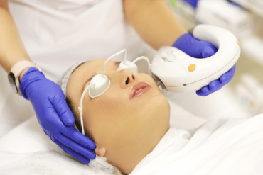 IPL photofacial near Fairfax VA