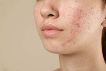 Laser resurfacing for acne scars in Fairfax VA