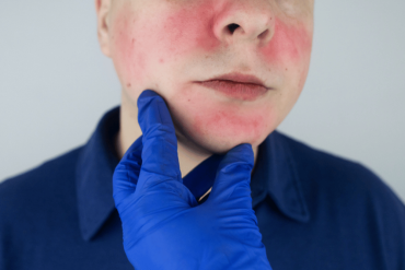 Photofacial IPL BBL treatment in Fairfax VA