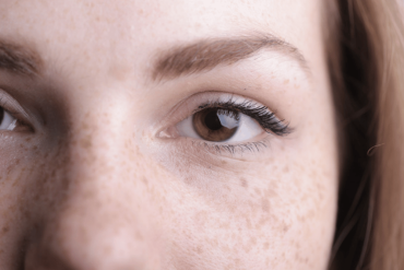 Sun damage and dark spots in Fairfax VA