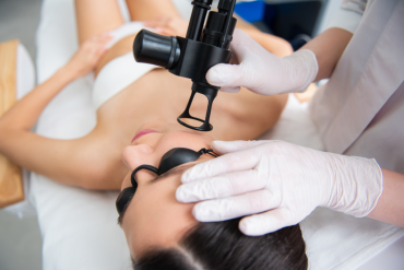HALO Laser Skin Resurfacing Near Vienna VA
