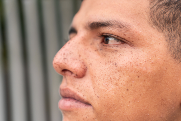 HALO Laser Treatment Near Tysons VA