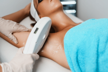 Laser Hair Removal for Dark Skin in Fairfax VA